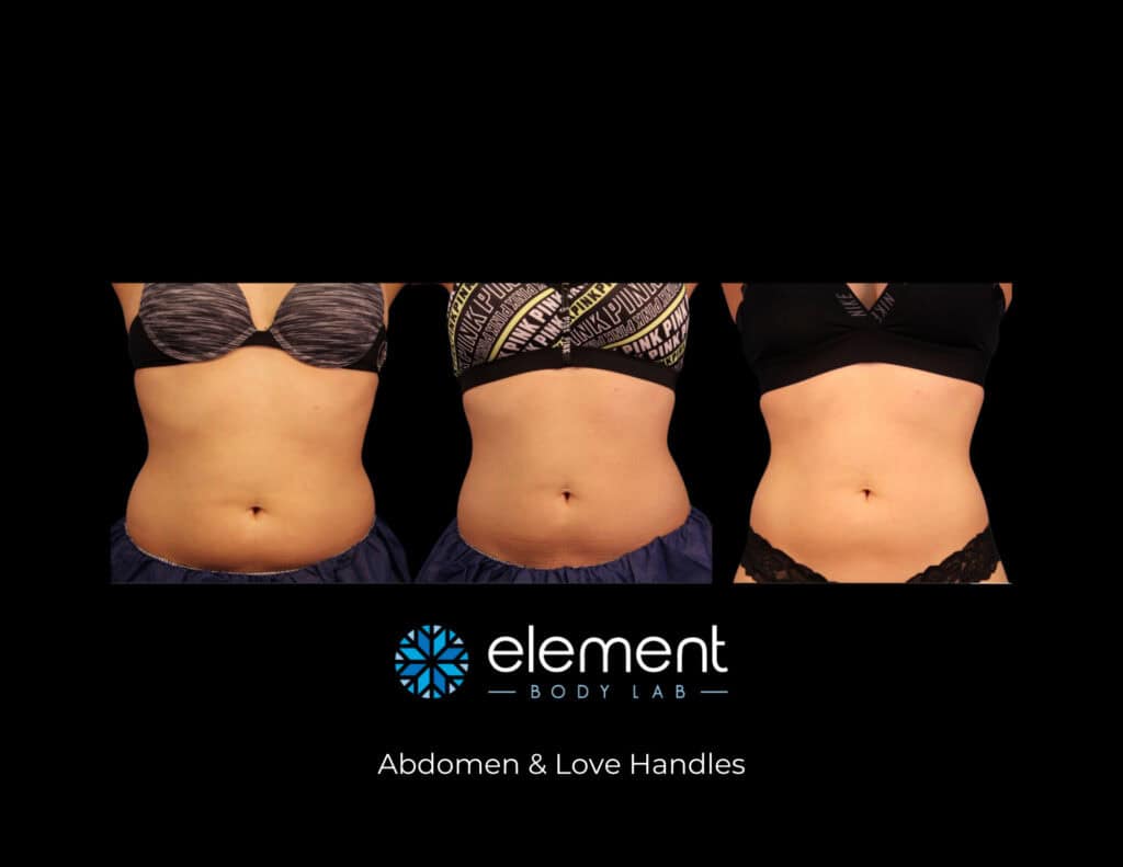 abdomen and love handle before and after CoolSculpting result