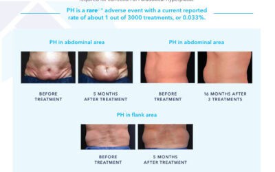 What is Paradoxical Adipose Hyperplasia?