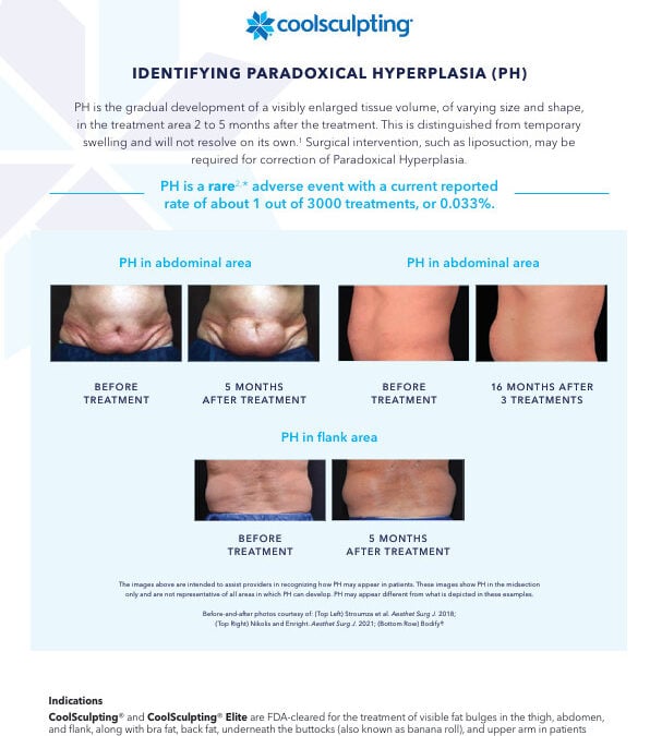 What is Paradoxical Adipose Hyperplasia?