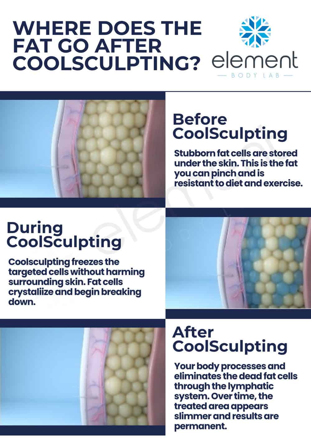 where does the fat go after CoolSculpting?